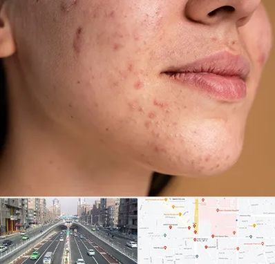 درمان جای جوش در توحید 