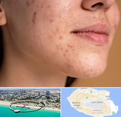 درمان جای جوش در کیش