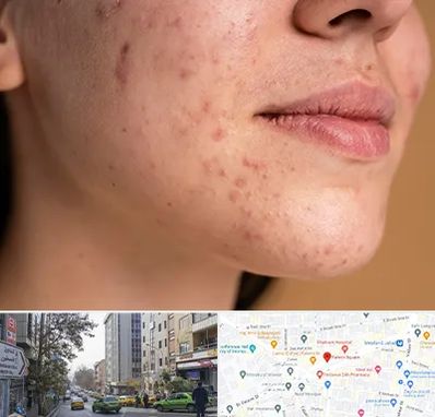 درمان جای جوش در فاطمی 