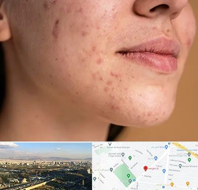 درمان جای جوش در هنگام 