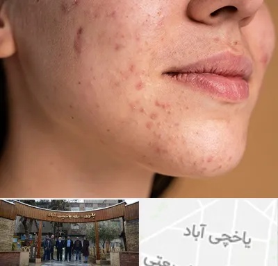 درمان جای جوش در یاخچی آباد