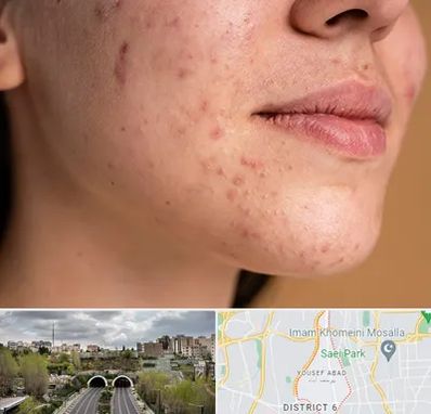 درمان جای جوش در یوسف آباد 