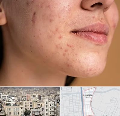 درمان جای جوش در اسکندری