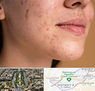 درمان جای جوش در نارمک 