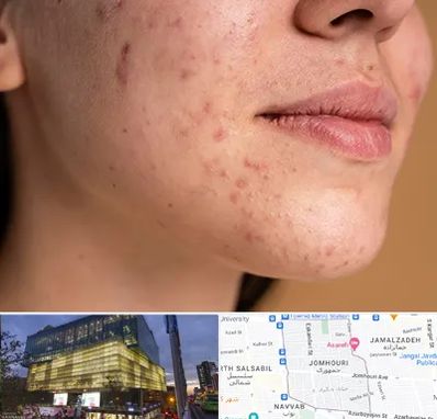 درمان جای جوش در جمهوری 