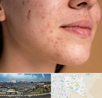 درمان جای جوش در منطقه 15 تهران 