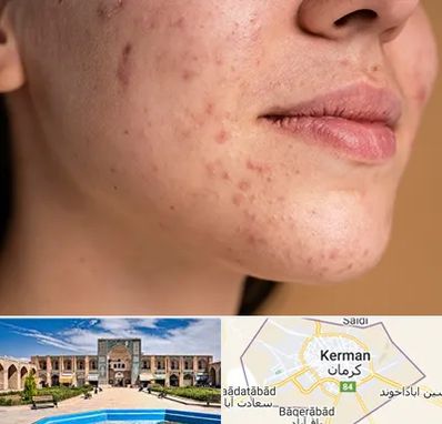درمان جای جوش در کرمان