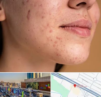 درمان جای جوش در لاله پارک تبریز