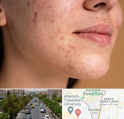 درمان جای جوش در شهران 