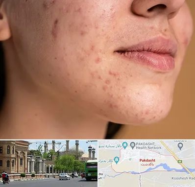 درمان جای جوش در پاکدشت