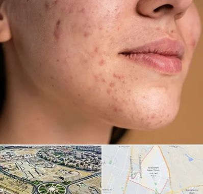 درمان جای جوش در اندیشه