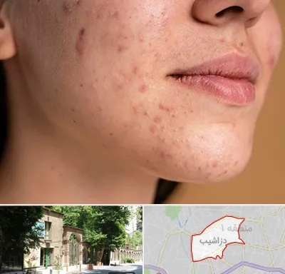 درمان جای جوش در دزاشیب