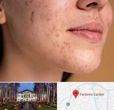 درمان جای جوش در باغ فردوس