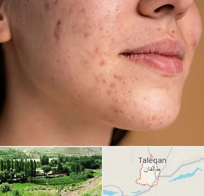 درمان جای جوش در طالقان