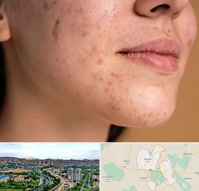 درمان جای جوش در شهریار