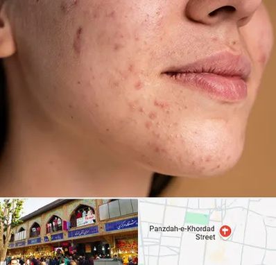 درمان جای جوش در 15 خرداد