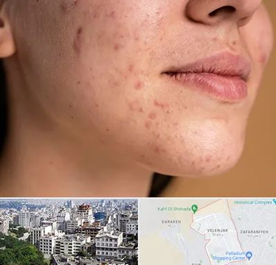 درمان جای جوش در ولنجک 