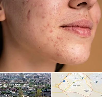 درمان جای جوش در رباط کریم