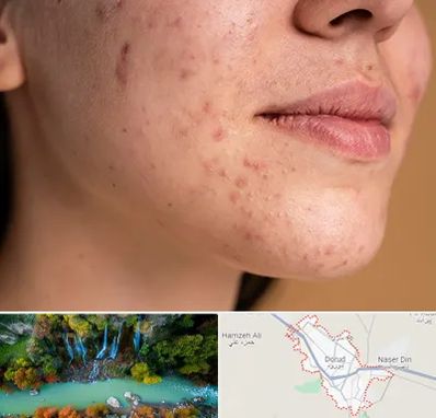 درمان جای جوش در دورود