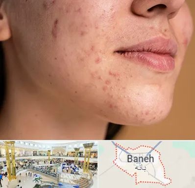 درمان جای جوش در بانه