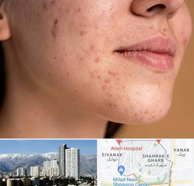 درمان جای جوش در شهرک غرب 