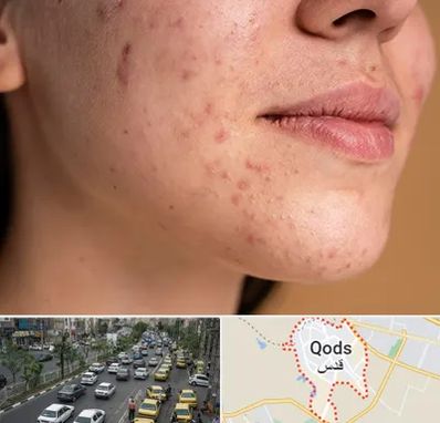 درمان جای جوش در شهر قدس