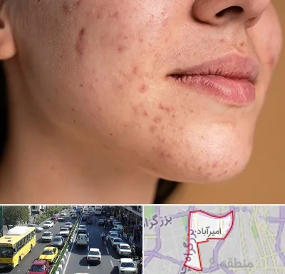درمان جای جوش در امیرآباد
