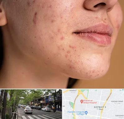 درمان جای جوش در ظفر 