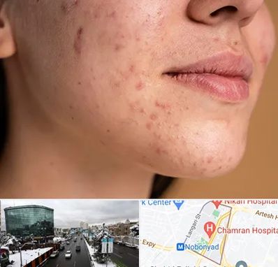 درمان جای جوش در اقدسیه 