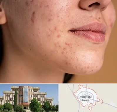 درمان جای جوش در دهدشت