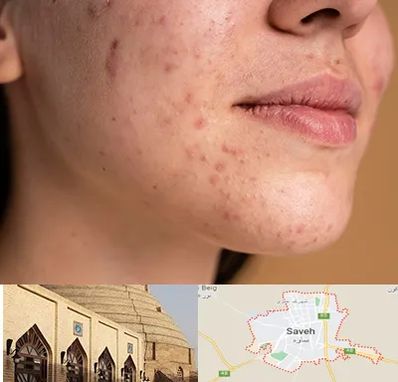 درمان جای جوش در ساوه