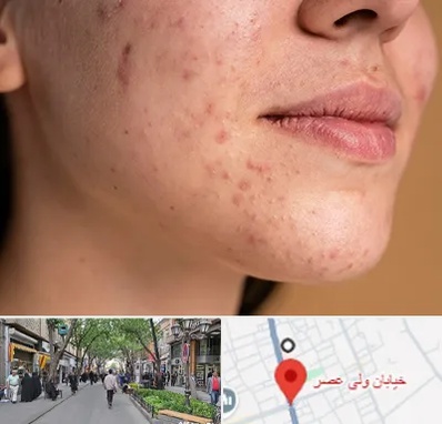 درمان جای جوش در ولیعصر شهریار