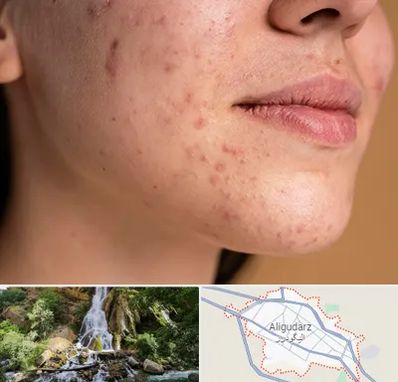 درمان جای جوش در الیگودرز