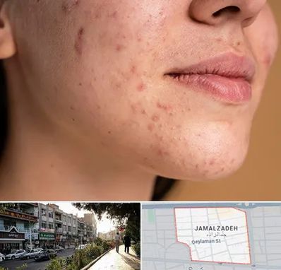 درمان جای جوش در خیابان جمالزاده