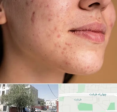 درمان جای جوش در طرشت