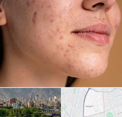 درمان جای جوش در جمشیدیه