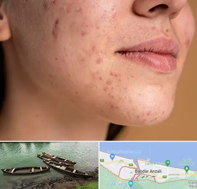 درمان جای جوش در بندر انزلی