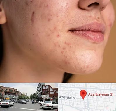 درمان جای جوش در خیابان آذربایجان