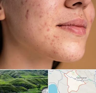 درمان جای جوش در گچساران
