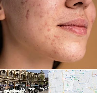 درمان جای جوش در منطقه 11 تهران 