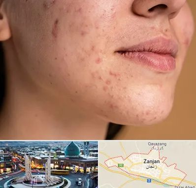 درمان جای جوش در زنجان