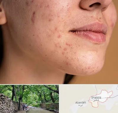 درمان جای جوش در شاندیز مشهد