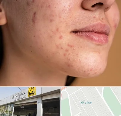درمان جای جوش در عبدل آباد