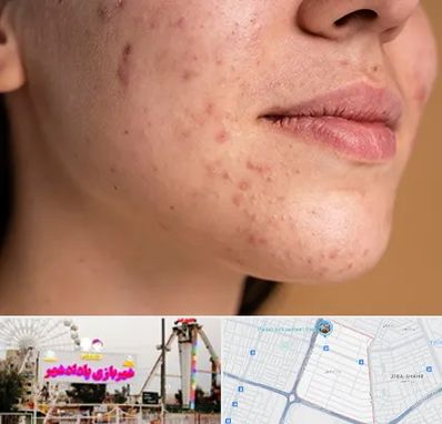 درمان جای جوش در پادادشهر اهواز