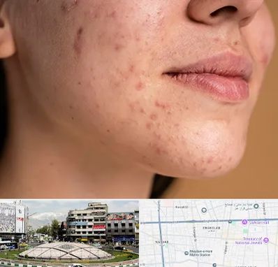 درمان جای جوش در مرکز تهران