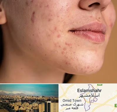 درمان جای جوش در اسلامشهر