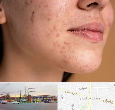 درمان جای جوش در میدان خراسان