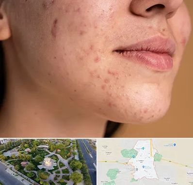 درمان جای جوش در کاشمر