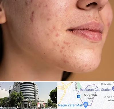 درمان جای جوش در قلهک 