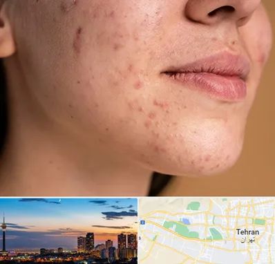 درمان جای جوش در غرب تهران 